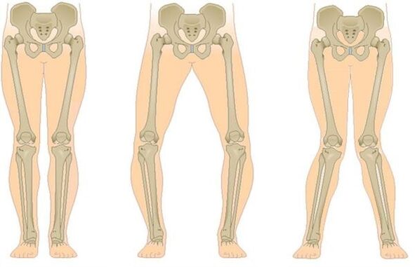 Types d'arthrose