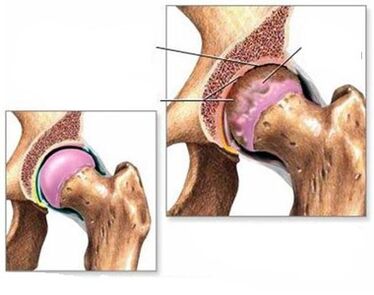 Arthrose de l'articulation de la hanche