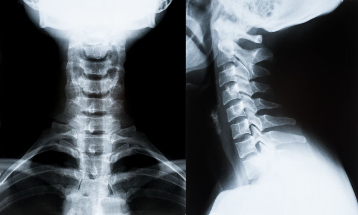 ostéochondrose cervicale à la radiographie