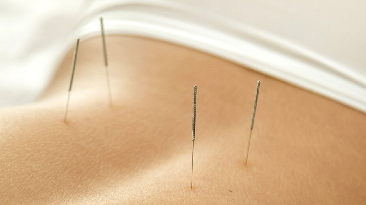 L'acupuncture aide à soulager les douleurs lombaires